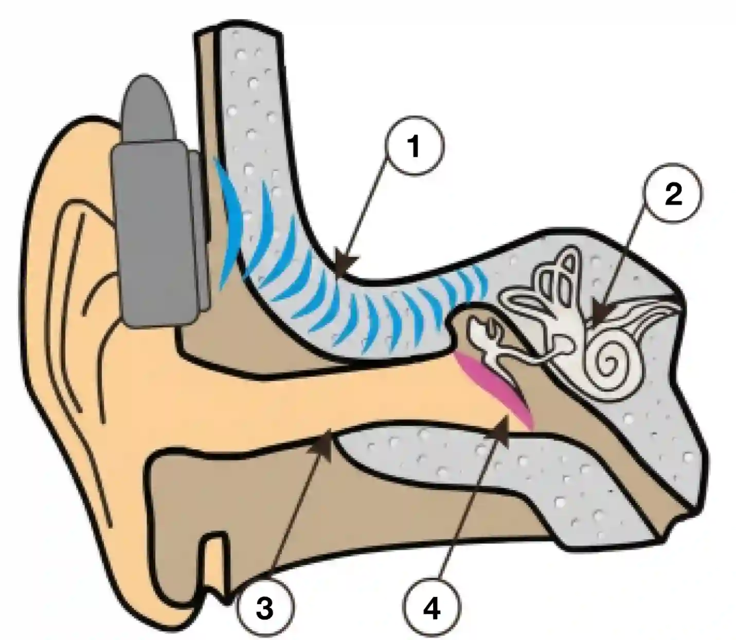 Coupe de l'oreille : le casque posé derrière l'oreille fait vibrer l'os temporal et les vibrations atteignent directement la cochlée.